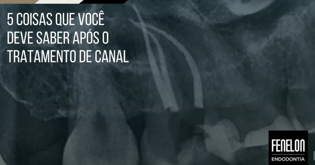 5 coisas que você deve saber após o tratamento de canal
