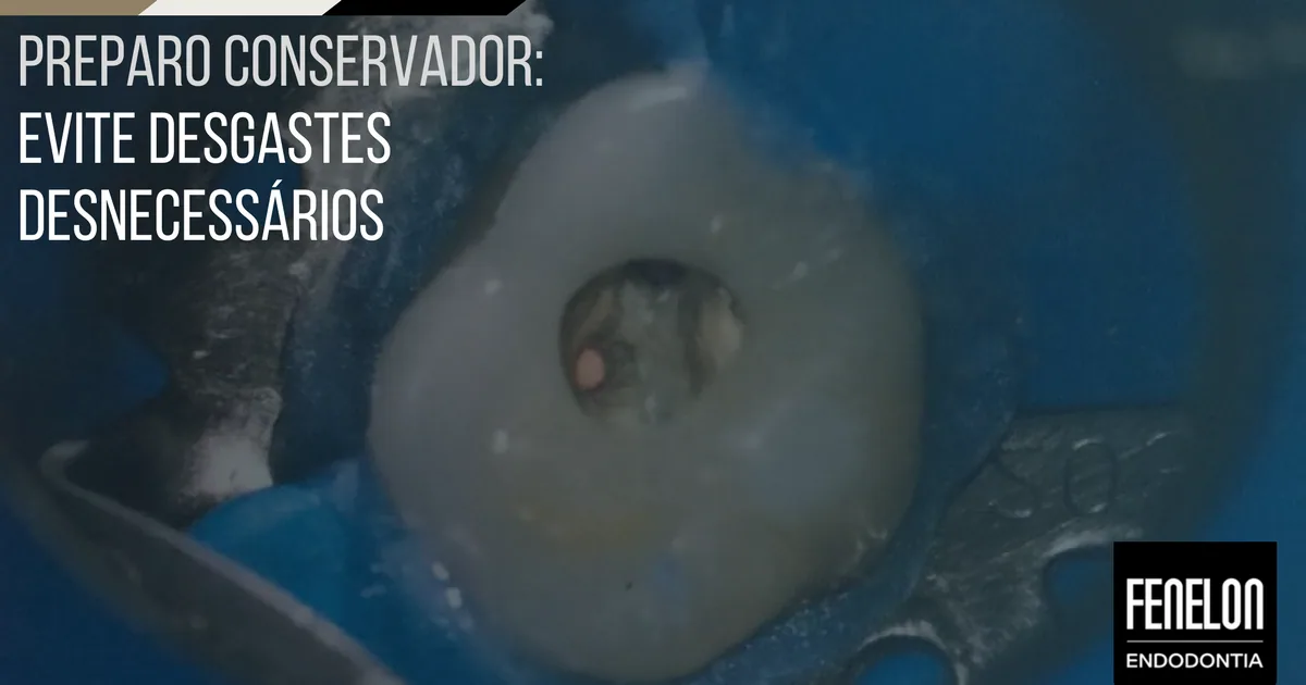 Preparo conservador: evite desgastes desnecessários