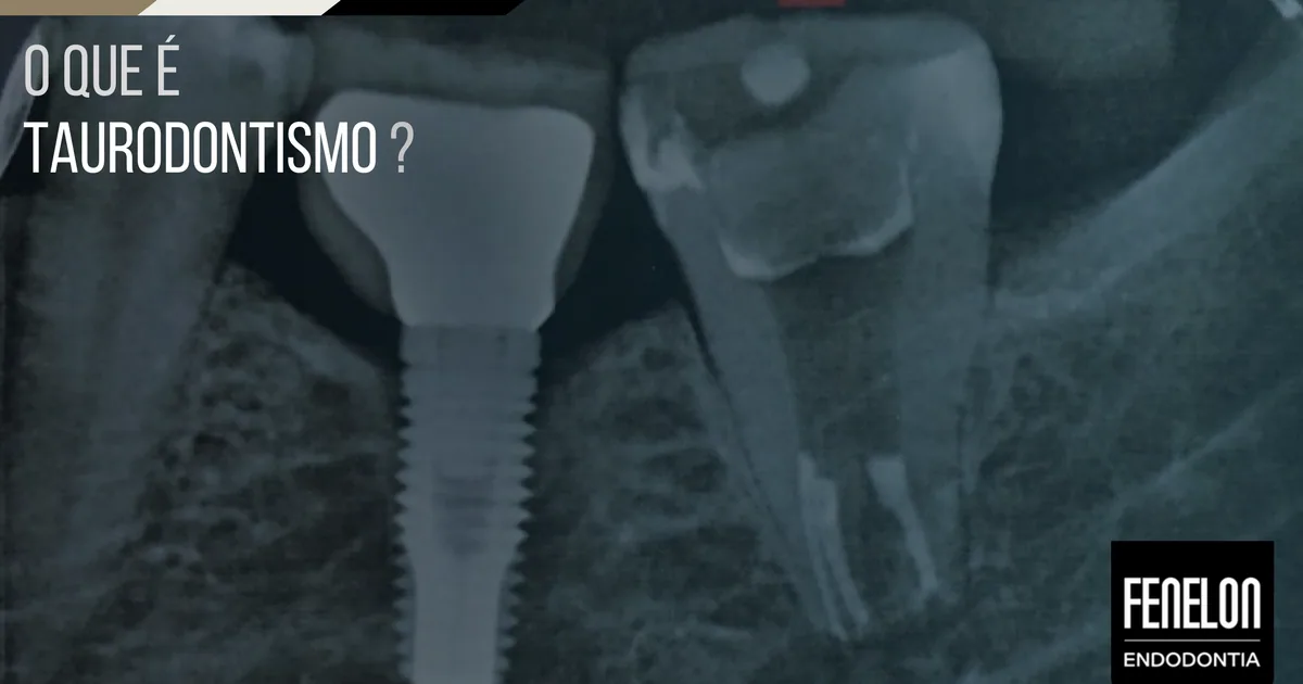 O que é Taurodontismo?