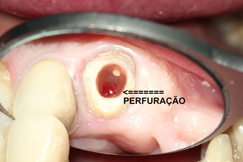 Tratamento de Perfurações
